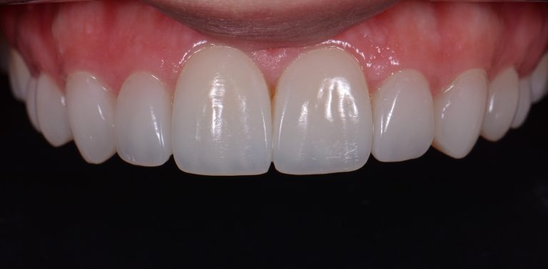 Composite Resin Veneers – Buying or Starting a Dental Practice